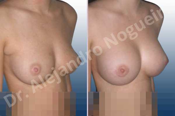 Cross eyed breasts,Small breasts,Anatomical shape,Lower hemi periareolar incision,Subfascial pocket plane - photo 5
