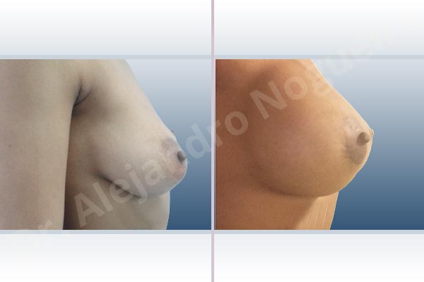 Asymmetric breasts,Cross eyed breasts,Empty breasts,Lateral breasts,Mildly saggy droopy breasts,Small breasts,Too far apart wide cleavage breasts,Anatomical shape,Extra large size,Lower hemi periareolar incision,Subfascial pocket plane - photo 4