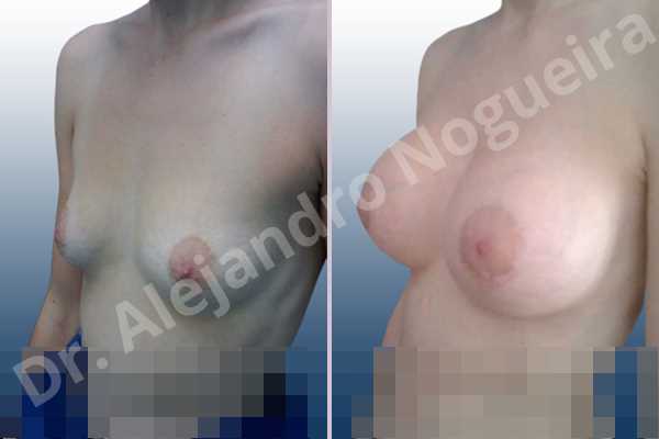 Empty breasts,Narrow breasts,Skinny breasts,Small breasts,Lower hemi periareolar incision,Round shape,Subfascial pocket plane - photo 3