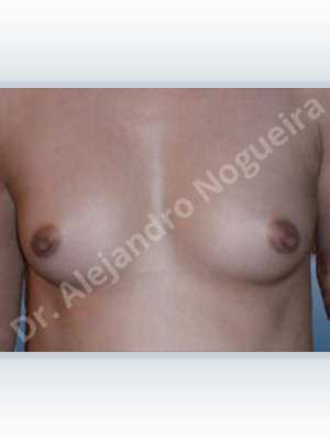 Asymmetric breasts,Narrow breasts,Small breasts,Anatomical shape,Inframammary incision,Subfascial pocket plane