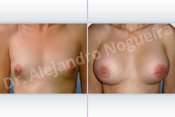 Cross eyed breasts,Large areolas,Lateral breasts,Narrow breasts,Skinny breasts,Small breasts,Too far apart wide cleavage breasts,Tuberous breasts,Anatomical shape,Areola reduction,Circumareolar incision,Subfascial pocket plane,Tuberous mammoplasty - photo 1