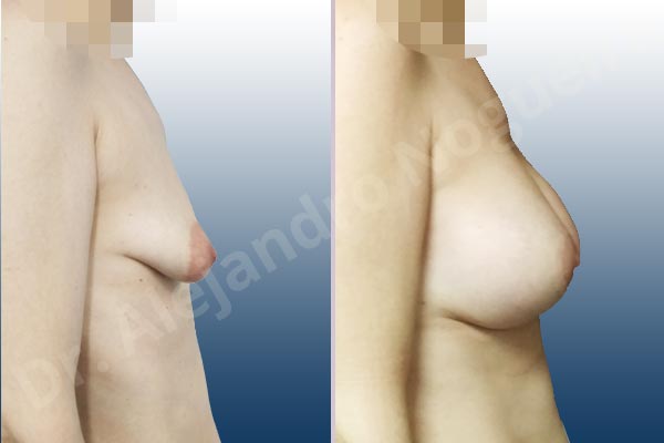 Asymmetric breasts,Empty breasts,Large areolas,Lateral breasts,Mildly saggy droopy breasts,Moderately saggy droopy breasts,Narrow breasts,Pendulous breasts,Skinny breasts,Small breasts,Sunken chest,Too far apart wide cleavage breasts,Tuberous breasts,Anatomical shape,Areola reduction,Circumareolar incision,Subfascial pocket plane,Tuberous mammoplasty - photo 4