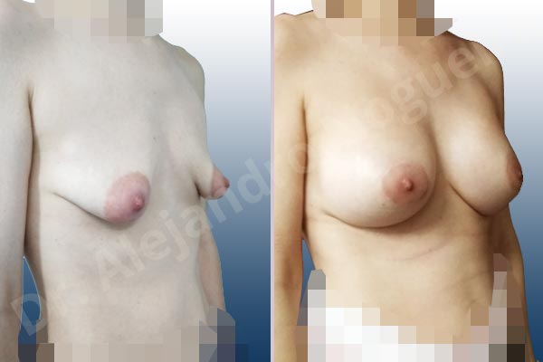 Asymmetric breasts,Empty breasts,Large areolas,Lateral breasts,Mildly saggy droopy breasts,Moderately saggy droopy breasts,Narrow breasts,Pendulous breasts,Skinny breasts,Small breasts,Sunken chest,Too far apart wide cleavage breasts,Tuberous breasts,Anatomical shape,Areola reduction,Circumareolar incision,Subfascial pocket plane,Tuberous mammoplasty - photo 5