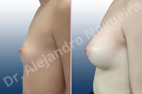 Asymmetric breasts,Empty breasts,Lateral breasts,Small breasts,Too far apart wide cleavage breasts,Anatomical shape,Lower hemi periareolar incision,Subfascial pocket plane - photo 2
