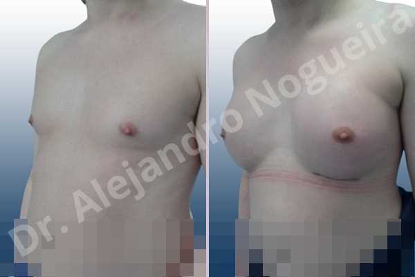 Cross eyed breasts,Empty breasts,Lateral breasts,Small breasts,Too far apart wide cleavage breasts,Transgender breasts,Wide breasts,Inframammary incision,Round shape,Subfascial pocket plane - photo 3