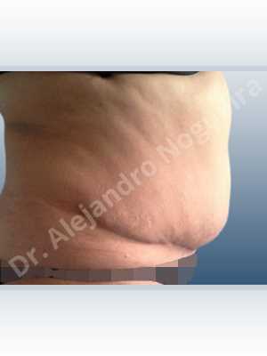 Displaced malpositioned scars,Failed tummy tuck,Saggy abdomen,Weak abdomen muscles,Excisional scar revision,Panniculectomy,Standard abdominoplasty