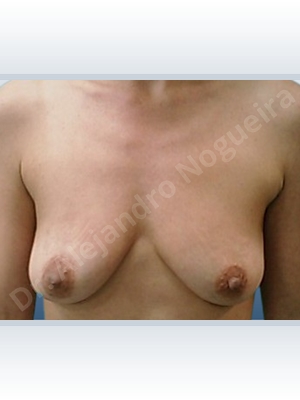 Asymmetric breasts,Empty breasts,Lateral breasts,Mildly saggy droopy breasts,Moderately saggy droopy breasts,Pendulous breasts,Skinny breasts,Small breasts,Anatomical shape,Lollipop incision,Subfascial pocket plane,Superior pedicle