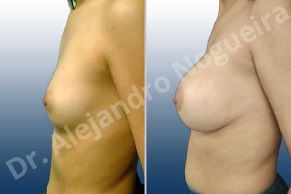 Asymmetric breasts,Empty breasts,Lateral breasts,Skinny breasts,Small breasts,Too far apart wide cleavage breasts,Extra large size,Lower hemi periareolar incision,Round shape,Dual plane pocket - photo 2