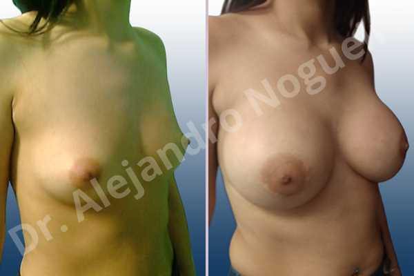 Asymmetric breasts,Empty breasts,Lateral breasts,Skinny breasts,Small breasts,Too far apart wide cleavage breasts,Extra large size,Lower hemi periareolar incision,Round shape,Dual plane pocket - photo 5