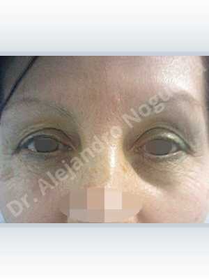 Baggy lower eyelids,Saggy upper eyelids,Upper eyelids ptosis,Lower eyelid fat bags resection,Transconjunctival approach incision,Upper eyelid skin and muscle resection
