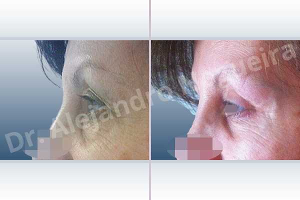 Baggy lower eyelids,Saggy upper eyelids,Upper eyelids ptosis,Lower eyelid fat bags resection,Transconjunctival approach incision,Upper eyelid skin and muscle resection - photo 2