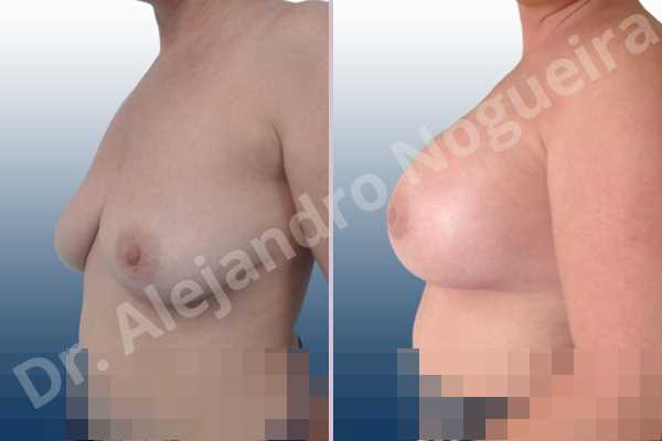 Empty breasts,Lateral breasts,Mildly large breasts,Moderately saggy droopy breasts,Slightly large breasts,Too far apart wide cleavage breasts,Wide breasts,Anatomical shape,Extra large size,Lower hemi periareolar incision,Subfascial pocket plane - photo 2