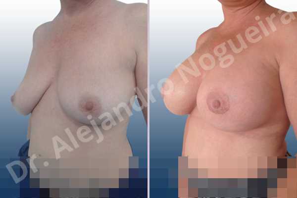 Empty breasts,Lateral breasts,Mildly large breasts,Moderately saggy droopy breasts,Slightly large breasts,Too far apart wide cleavage breasts,Wide breasts,Anatomical shape,Extra large size,Lower hemi periareolar incision,Subfascial pocket plane - photo 3