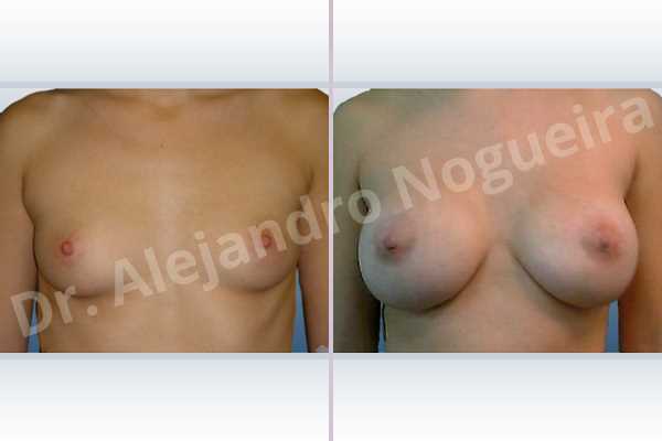 Lateral breasts,Small breasts,Too far apart wide cleavage breasts,Lower hemi periareolar incision,Round shape,Subfascial pocket plane - photo 1