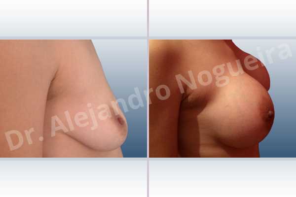 Asymmetric breasts,Empty breasts,Moderately saggy droopy breasts,Narrow breasts,Pendulous breasts,Pigeon chest,Small breasts,Too far apart wide cleavage breasts,Extra large size,Lower hemi periareolar incision,Round shape,Subfascial pocket plane - photo 4