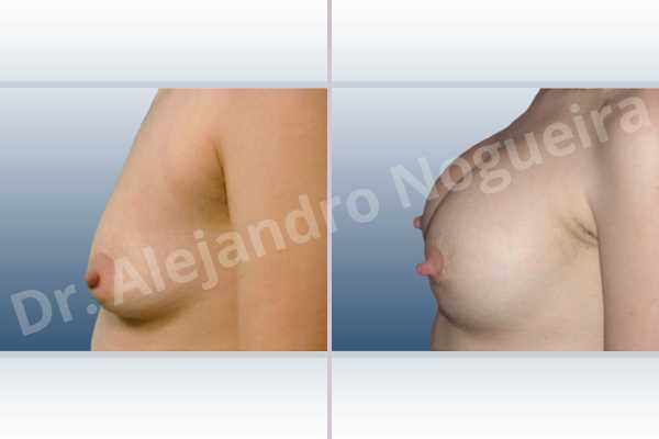 Asymmetric breasts,Empty breasts,Lateral breasts,Narrow breasts,Skinny breasts,Slightly saggy droopy breasts,Small breasts,Too far apart wide cleavage breasts,Tuberous breasts,Lower hemi periareolar incision,Round shape,Subfascial pocket plane,Tuberous mammoplasty - photo 2
