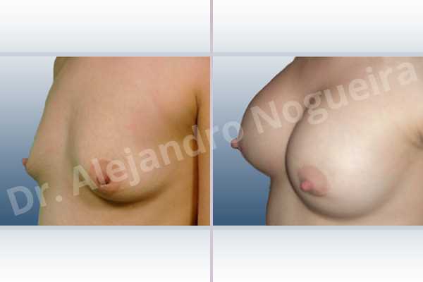 Asymmetric breasts,Empty breasts,Lateral breasts,Narrow breasts,Skinny breasts,Slightly saggy droopy breasts,Small breasts,Too far apart wide cleavage breasts,Tuberous breasts,Lower hemi periareolar incision,Round shape,Subfascial pocket plane,Tuberous mammoplasty - photo 3
