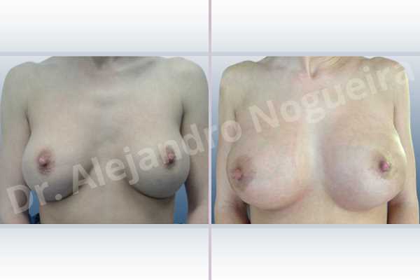 Breast implants lateral slide,Breast implants side boob,Cross eyed breasts implants,Empty breasts,Slightly saggy droopy breasts,Small breasts,Sunken chest,Too far apart wide cleavage breast implants,Too far apart wide cleavage breasts,Too narrow breast implants,Wide breasts,Anatomical shape,Capsulectomy,Internal bra capsulorrhaphy,Lower hemi periareolar incision,Subfascial pocket plane - photo 1
