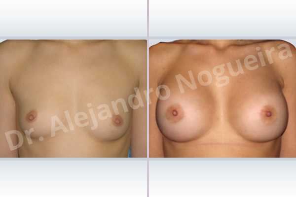 Asymmetric breasts,Cross eyed breasts,Skinny breasts,Small breasts,Lower hemi periareolar incision,Round shape,Subfascial pocket plane - photo 1