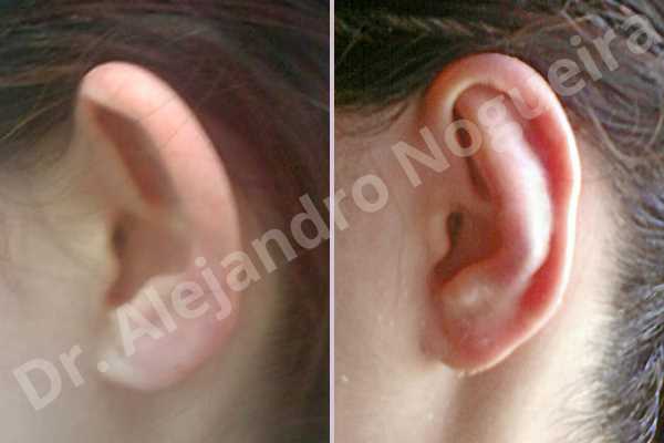 Prominent ears,Mustardé antihelical suturing - photo 1