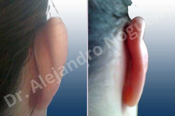 Prominent ears,Mustardé antihelical suturing - photo 4