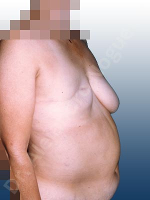 Asymmetric breasts,Severely saggy droopy breasts,Breast loss mastectomy,Free nipple areola complex graft,Lollipop incision,Nipple areola complex reconstruction,Superior pedicle,Unilateral TRAM flap breast reconstruction