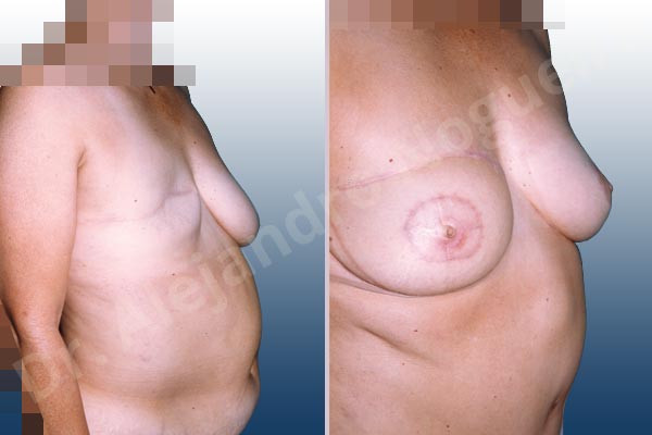 Asymmetric breasts,Severely saggy droopy breasts,Breast loss mastectomy,Free nipple areola complex graft,Lollipop incision,Nipple areola complex reconstruction,Superior pedicle,Unilateral TRAM flap breast reconstruction - photo 1