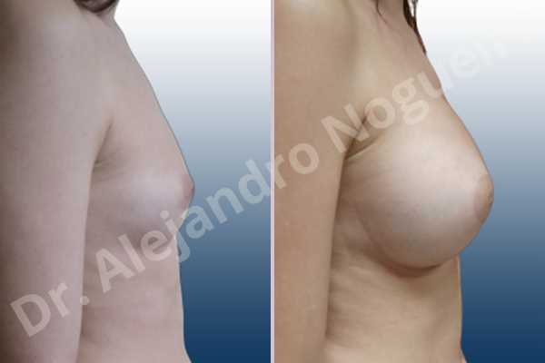Asymmetric breasts,Cleft nipples,Empty breasts,Inverted nipples,Narrow breasts,Small breasts,Anatomical shape,Circumareolar incision,Extra large size,Subfascial pocket plane - photo 4
