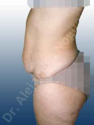 Weak abdomen muscles,Saggy abdomen,Standard abdominoplasty