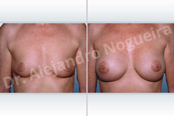 Empty breasts,Slightly saggy droopy breasts,Small breasts,Anatomical shape,Lower hemi periareolar incision,Subfascial pocket plane - photo 1