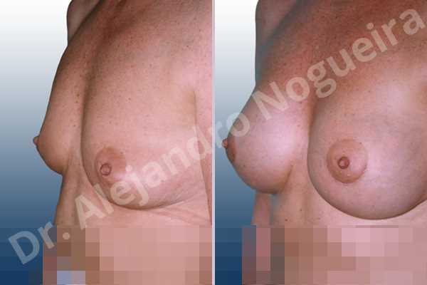 Empty breasts,Slightly saggy droopy breasts,Small breasts,Anatomical shape,Lower hemi periareolar incision,Subfascial pocket plane - photo 2