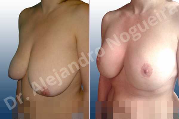 Asymmetric breasts,Empty breasts,Extremely saggy droopy breasts,Moderately large breasts,Pendulous breasts,Severely saggy droopy breasts,Wide breasts,Anatomical shape,Anchor incision,Double vertical pedicle,Extra large size,Subfascial pocket plane - photo 3