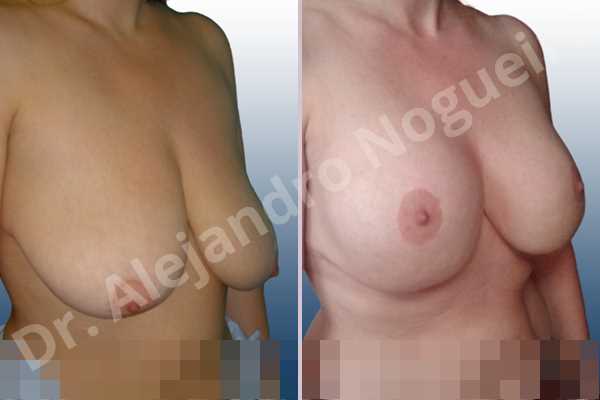 Asymmetric breasts,Empty breasts,Extremely saggy droopy breasts,Moderately large breasts,Pendulous breasts,Severely saggy droopy breasts,Wide breasts,Anatomical shape,Anchor incision,Double vertical pedicle,Extra large size,Subfascial pocket plane - photo 5
