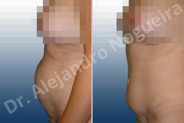 Saggy abdomen,Sunken scars,Weak abdomen muscles,Standard abdominoplasty - photo 2