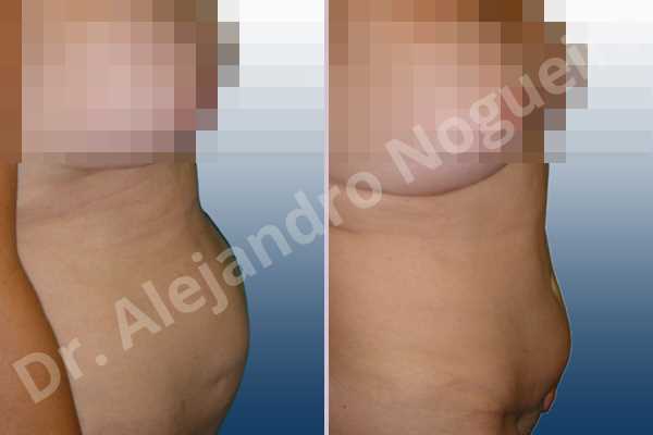 Saggy abdomen,Sunken scars,Weak abdomen muscles,Standard abdominoplasty - photo 4