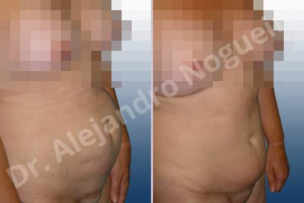 Saggy abdomen,Sunken scars,Weak abdomen muscles,Standard abdominoplasty - photo 5