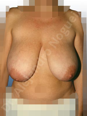 Breast tissue bottoming out,Extremely saggy droopy breasts,Large areolas,Moderately large breasts,Pendulous breasts,Tuberous breasts,Anchor incision,Areola reduction,Double vertical pedicle