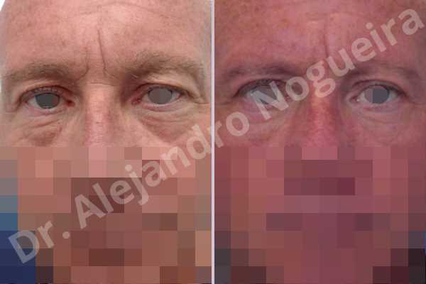 Baggy lower eyelids,Saggy upper eyelids,Upper eyelids ptosis,Lower eyelid fat bags resection,Transconjunctival approach incision,Upper eyelid skin and muscle resection - photo 1