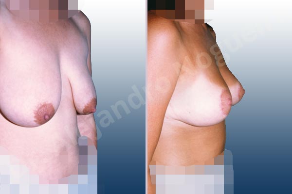 Severely saggy droopy breasts,Tuberous breasts,Lollipop incision,Superior pedicle - photo 1