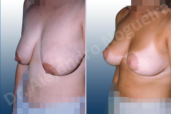 Severely saggy droopy breasts,Tuberous breasts,Lollipop incision,Superior pedicle - photo 2
