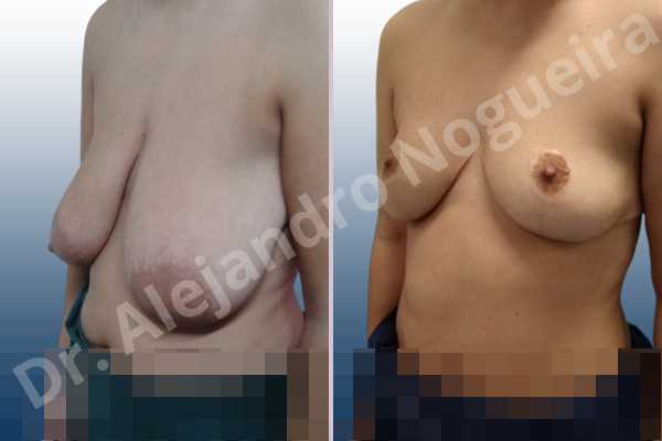 Asymmetric breasts,Empty breasts,Extremely saggy droopy breasts,Large areolas,Moderately large breasts,Pendulous breasts,Wide breasts,Tuberous breasts,Anchor incision,Areola reduction,Double vertical pedicle - photo 3