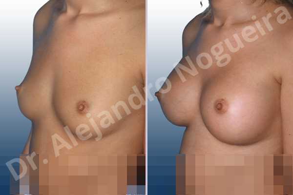 Small breasts,Wide breasts,Anatomical shape,Inframammary incision,Subfascial pocket plane - photo 1