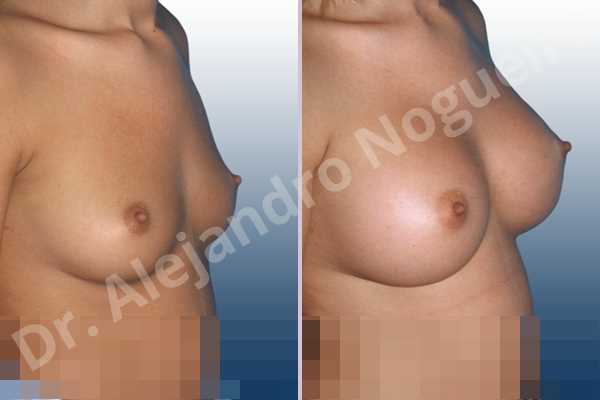 Small breasts,Wide breasts,Anatomical shape,Inframammary incision,Subfascial pocket plane - photo 2
