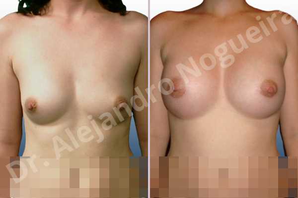 Asymmetric breasts,Cross eyed breasts,Small breasts,Anatomical shape,Lower hemi periareolar incision,Subfascial pocket plane - photo 1