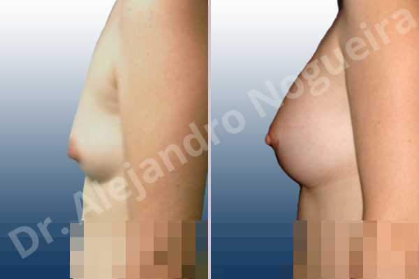 Asymmetric breasts,Cross eyed breasts,Small breasts,Anatomical shape,Lower hemi periareolar incision,Subfascial pocket plane - photo 2
