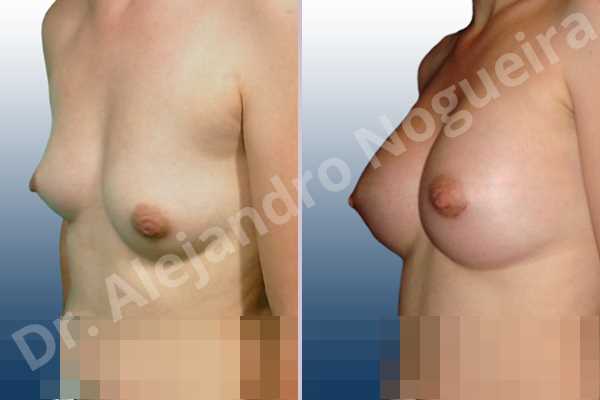 Asymmetric breasts,Cross eyed breasts,Small breasts,Anatomical shape,Lower hemi periareolar incision,Subfascial pocket plane - photo 3