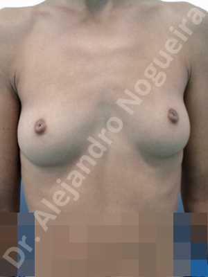 Cleft nipples,Cross eyed breasts implants,Empty breasts,Inverted nipples,Lateral breasts,Narrow breasts,Skinny breasts,Small breasts,Sunken chest,Anatomical shape,Extra large size,Inframammary incision,Subfascial pocket plane