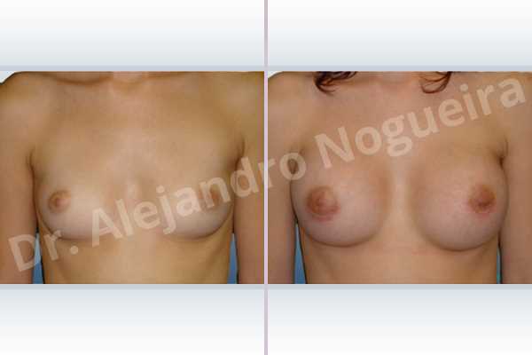 Asymmetric breasts,Cross eyed breasts,Lateral breasts,Narrow breasts,Skinny breasts,Sunken chest,Too far apart wide cleavage breasts,Lower hemi periareolar incision,Round shape,Subfascial pocket plane - photo 1