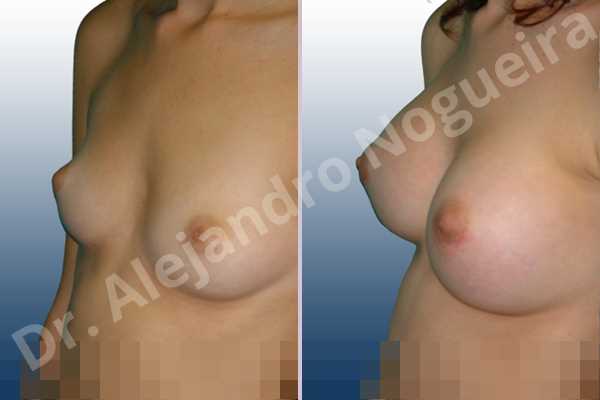 Asymmetric breasts,Cross eyed breasts,Lateral breasts,Narrow breasts,Skinny breasts,Sunken chest,Too far apart wide cleavage breasts,Lower hemi periareolar incision,Round shape,Subfascial pocket plane - photo 3