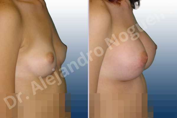 Asymmetric breasts,Cross eyed breasts,Lateral breasts,Narrow breasts,Skinny breasts,Sunken chest,Too far apart wide cleavage breasts,Lower hemi periareolar incision,Round shape,Subfascial pocket plane - photo 4